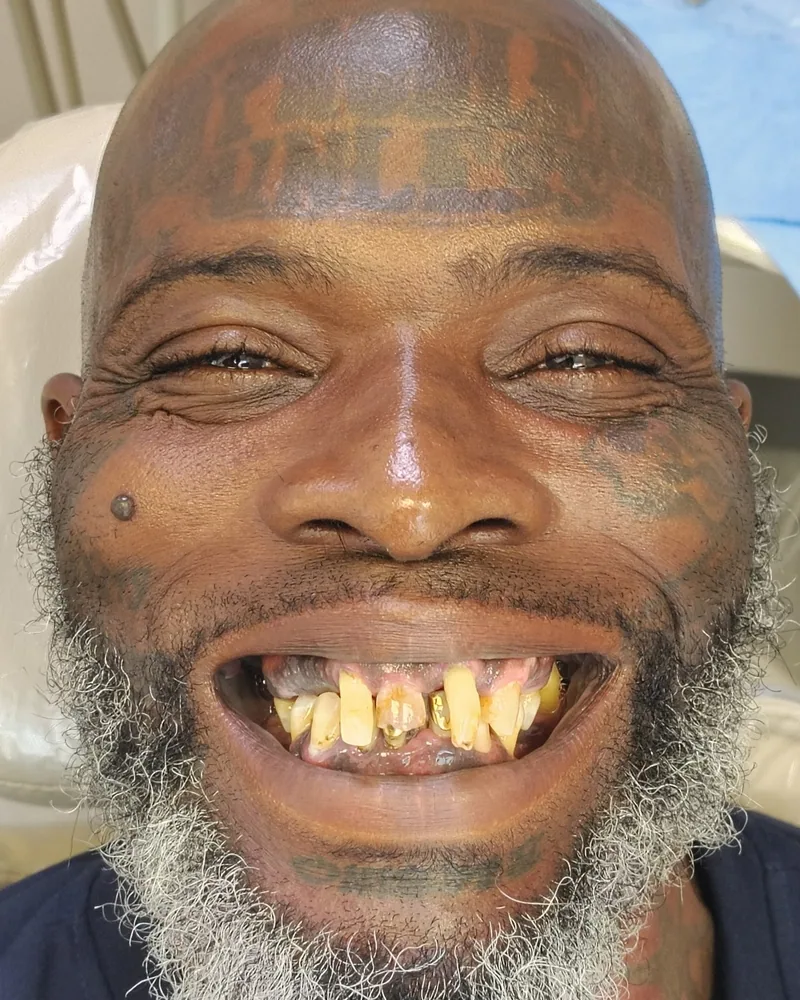 Patient before treatment at Frenchy Smiles: worn, darkened and irregular upper and lower teeth.
