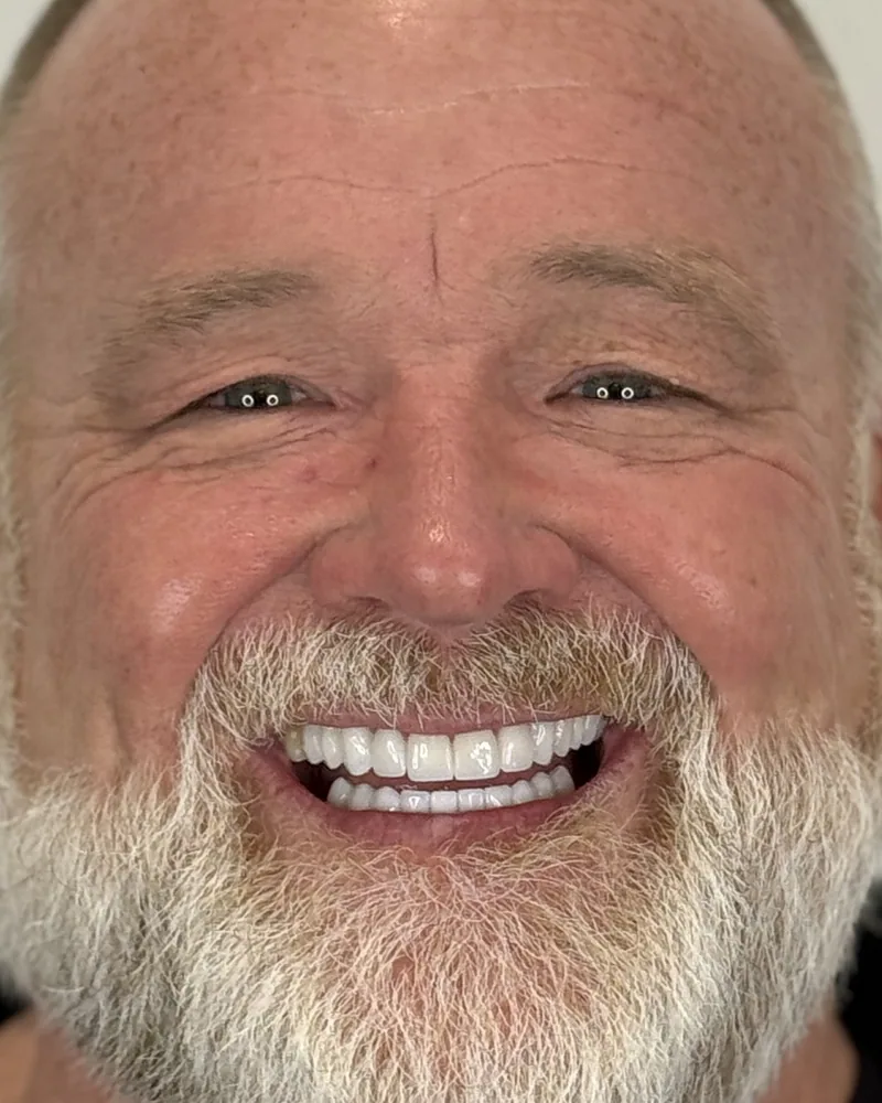 The same patient after porcelain veneers: a full, even smile in matched porcelain.