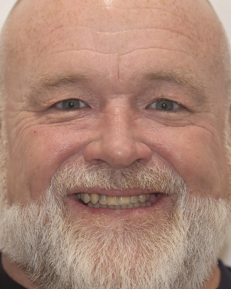Patient before treatment at Frenchy Smiles: short, discolored and unevenly worn upper teeth.