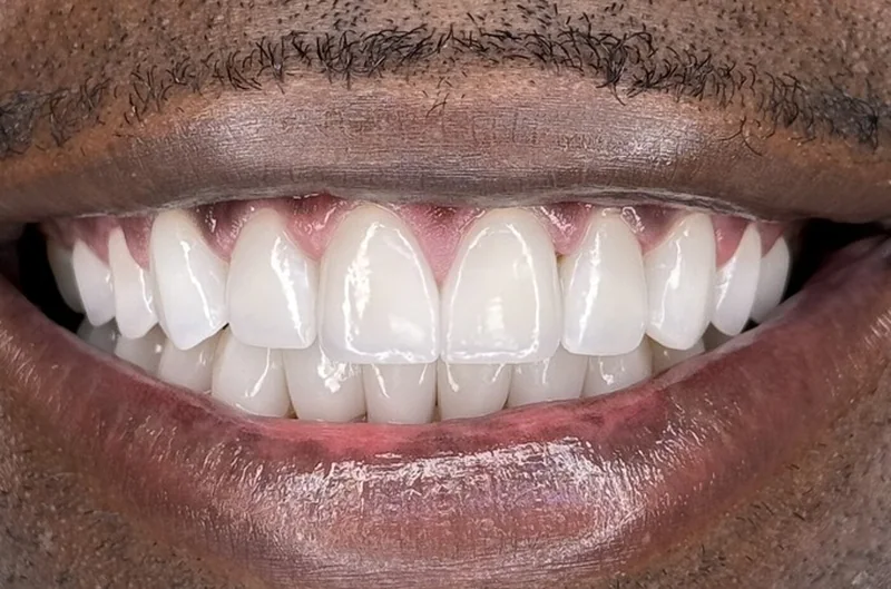 The same patient after porcelain veneers: an even, closed smile in matched porcelain.