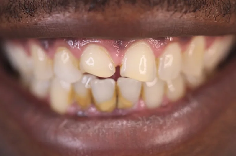 Patient before treatment: spaced, worn and discolored upper front teeth.