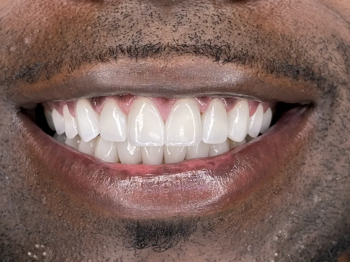 Macro photograph of the full-arch case's finished smile: individual surface texture and translucency in the porcelain.
