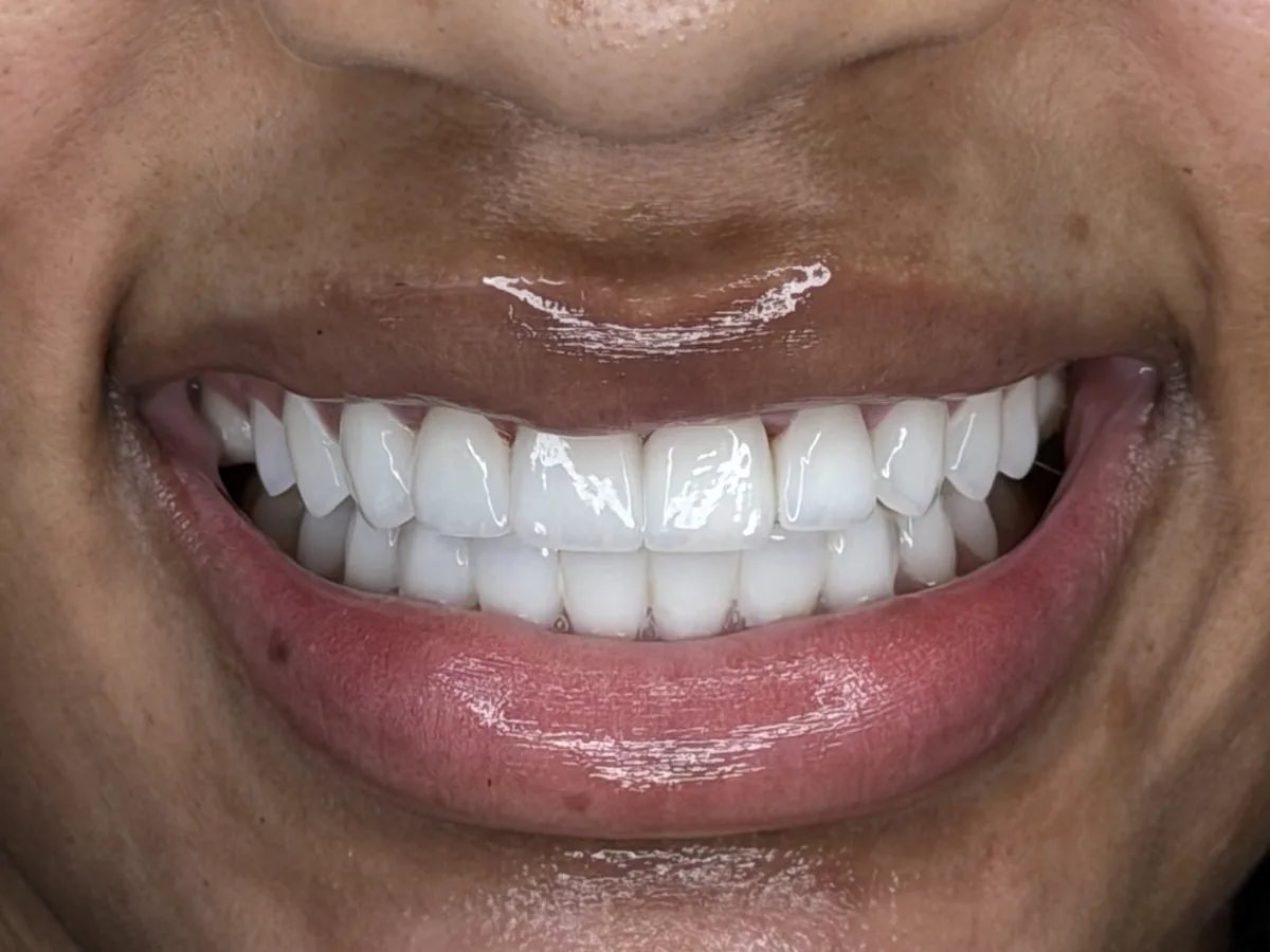 Macro photograph of a finished porcelain smile, close enough to show the hand-layered shade variation.