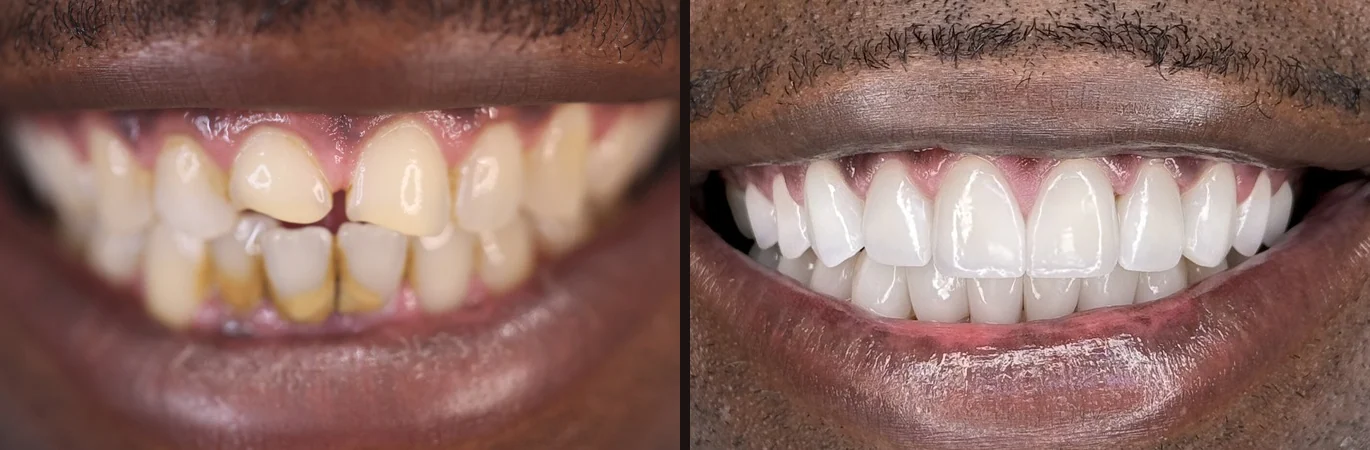 An actual Frenchy Smiles patient: the same smile before and after porcelain veneers.